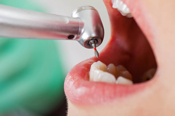 Best Emergency Treatment for Dental Infections or Abscesses in Dalworthington Gardens, TX